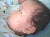 赤ちゃんの突発性発疹の症状・画像 - Photo No.4